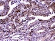 IHC testing of FFPE human intestinal cancer tissue with MED18 antibody at 1ug/ml. Required HIER: steam section in pH6 citrate buffer for 20 min and allow to cool prior to testing.