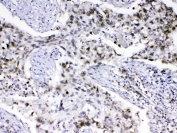 IHC testing of FFPE human lung cancer tissue with MED18 antibody at 1ug/ml. Required HIER: steam section in pH6 citrate buffer for 20 min and allow to cool prior to testing.
