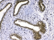 IHC testing of FFPE human breast cancer tissue with MED18 antibody at 1ug/ml. Required HIER: steam section in pH6 citrate buffer for 20 min and allow to cool prior to testing.