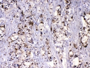 IHC testing of FFPE human breast cancer tissue with MED9 antibody at 1ug/ml. Required HIER: steam section in pH6 citrate buffer for 20 min and allow to cool prior to testing.