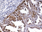 IHC testing of FFPE human lung cancer tissue with MED9 antibody at 1ug/ml. Required HIER: steam section in pH6 citrate buffer for 20 min and allow to cool prior to testing.
