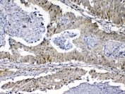 IHC testing of FFPE human colon cancer tissue with MED9 antibody at 1ug/ml. Required HIER: steam section in pH6 citrate buffer for 20 min and allow to cool prior to testing.