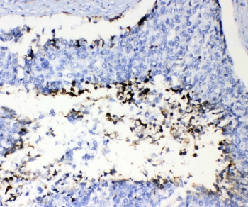 IHC testing of FFPE human lung cancer tissue with Prothrombin antibody at 1ug/ml. Required HIER: steam section in pH6 citrate buffer for 20 min and allow to cool prior to testing.