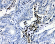 IHC testing of FFPE human colon cancer tissue with Prothrombin antibody at 1ug/ml. Required HIER: steam section in pH6 citrate buffer for 20 min and allow to cool prior to testing.