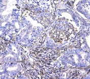 IHC testing of FFPE human colon cancer tissue with CD44 antibody at 1ug/ml. Required HIER: steam section in pH6 citrate buffer for 20 min and allow to cool prior to testing.