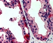IHC staining of FFPE human prostate with JIK antibody at 2.5ug/ml. HIER: steamed with pH6 citrate buffer, AP-staining.