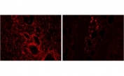 IHC staining of FFPE human pancreas with HMOX2 antibody at 2ug/ml: cancer tissue (left), adjacent to cancer tissue (right). HIER: steamed with pH6 citrate buffer, Alexa Fluor 594-staining.