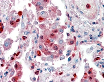 IHC staining of FFPE human lung with S100A9 antibody at 2.5ug/ml. HIER: steamed with pH6 citrate buffer, AP-staining.