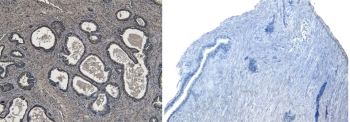 IHC testing of FFPE human prostate tissue with (left) and without (right) ROR1 anti