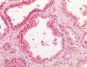 IHC staining of human prostate tissue with TDP-43 antibody. HIER: boil tissue sections in 10mM citrate buffer, pH 6, for 10-20 min followed by cooling at RT for 20 min.