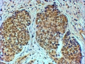 IHC testing of FFPE human breast cancer with TIF1A antibody at 4ug/ml. HIER: steamed with pH6 citrate buffer, HRP-staining.