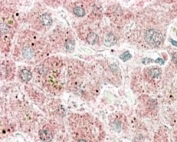 IHC staining of FFPE human liver with Apolipoprotein F antibody at 4ug/ml. HIER: steamed with pH6 citrate buffer, AP-staining. Image shows lipid droplet staining in the cytoplasm.