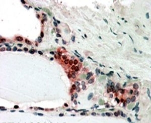 IHC testing of FFPE human thyroid gland with COPS2 antibody at 3ug/ml shows nclear and cytoplasm staining in activated