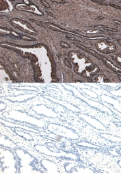 IHC staining of FFPE human prostate tissue with NUMB antibody at 5ug/ml (top) and no primary antibody (bottom). Required HIER: steamed antigen retrieval with pH6 citrate buffer; HRP-staining.