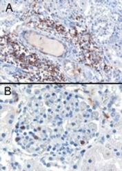 IHC staining of FFPE human kidney with SH3BP1 antibody at 0.3ug/ml. Figure A shows cytoplasmic staining of lymphocytes in the interstitial parenchyma of the kidney.  Figure B shows staining in a glomerulus of the kidney. HIER: microwaved with pH6 citrate buffer, HRP-staining.