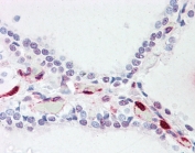 IHC testing of FFPE human thyroid with ATP13A1 antibody at 5ug/ml. Required HIER: steamed antigen retrieval with pH6 citrate buffer; AP-staining.