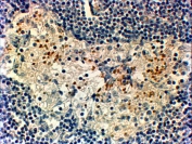 IHC staining of FFPE human breast cancer with FOXC2 antibody at 2ug/ml. HIER: steamed with pH9 Tris/EDTA buffer, HRP-staining.