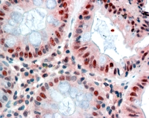 IHC staining of FFPE human colon with MBD2 antibody at 2.5ug/ml. HIER: steamed with pH6 citrate buffer, AP-stainin