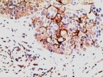 IHC testing of FFPE human breast carcinoma with EPS8 antibody at 5ug/ml. HIER: steamed with pH6 citrate buffer, AP-staining.