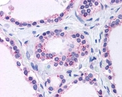 IHC testing of FFPE human thyroid tissue with RPL22 antibody at 3.75ug/ml. HIER: steamed with pH6 citrate buffer, AP-staining.