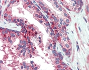 IHC testing of FFPE human prostate tissue with VPS35 antibody at 5ug/ml. Required HIER: steamed antigen retrieval with pH6 citrate buffer; AP-staining.
