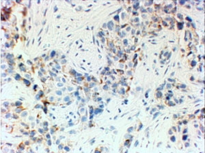 IHC: No staining of FFPE human breast cancer (triple negative/TNBC) seen with HER2 antibody at 4ug/ml. HI