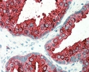 IHC staining of FFPE human prostate with ELMO3 antibody at 5ug/ml. HIER: steamed with pH6 citrate buffer, AP-staining. Vesiculate staining in the cytoplasm of secretory cells is seen.