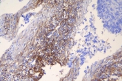 IHC staining of FFPE human lung cancer with ICAM1 antibody. HIER: boil tissue sections in pH8 EDTA for 20 min and allow to cool before testing.