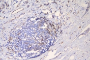 IHC staining of FFPE human brest cancer with ICAM1 antibody. HIER: boil tissue sections in pH8 EDTA for 20 min and allow to cool before testing.