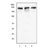 IHC testing of FFPE human rectal cancer tissue with Dnmt1 antibody at 1ug/ml. Required HIER: steam section in pH6 citrate buffer for 20 min and allow to cool prior to testing.