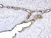 IHC testing of FFPE human breast cancer tissue with MUC1 antibody at 1ug/ml. Required HIER: steam section in pH6 citrate buffer for 20 min and allow to cool prior to testing.