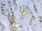 IHC testing of FFPE human colon cancer tissue with MUC1 antibody at 1ug/ml. Required HIER: steam section in pH6 citrate buffer for 20 min and allow to cool prior to testing.
