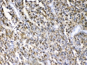 IHC testing of FFPE human glioma tissue with GFAP antibody at 1ug/ml. Required HIER: steam section in pH6 citrate buffer for 20 min and allow to cool prior to testing.