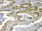 IHC testing of FFPE human colon cancer tissue with ERBB4 antibody at 1ug/ml. Required HIER: steam section in pH6 citrate buffer for 20 min and allow to cool prior to testing.