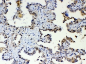 IHC testing of FFPE human lung cancer tissue with ETV6 antibody at 1ug/ml. Required HIER: steam section in pH6 citrate buffer for 20 min and allow to cool prior to testing.