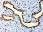 IHC testing of FFPE human breast cancer tissue with ETV6 antibody at 1ug/ml. Required HIER: steam section in pH6 citrate buffer for 20 min and allow to cool prior to testing.