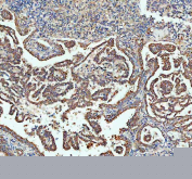IHC staining of FFPE human lung cancer tissue with Sacsin antibody, HRP-labeled secondary and DAB substrate. HIER: boil tissue sections in pH8 EDTA for 20 min and allow to cool before testing.
