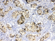 IHC testing of FFPE human breast cancer tissue with GALE antibody at 1ug/ml. Required HIER: steam section in pH6 citrate buffer for 20 min and allow to cool prior to testing.
