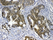IHC testing of FFPE human colon cancer tissue with GALE antibody at 1ug/ml. Required HIER: steam section in pH6 citrate buffer for 20 min and allow to cool prior to testing.