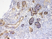 IHC testing of FFPE human lung cancer tissue with GALE antibody at 1ug/ml. Required HIER: steam section in pH6 citrate buffer for 20 min and allow to cool prior to testing.
