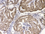 IHC testing of FFPE human colon cancer tissue with XRCC1 antibody at 1ug/ml. Required HIER: steam section in pH6 citrate buffer for 20 min and allow to cool prior to testing.