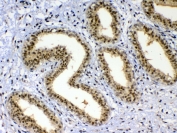 IHC testing of FFPE human breast cancer tissue with XRCC1 antibody at 1ug/ml. Required HIER: steam section in pH6 citrate buffer for 20 min and allow to cool prior to testing.