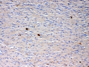 IHC testing of FFPE human glioma with NSF antibody at 1ug/ml. Required HIER: steam section in pH6 citrate buffer for 20 min and allow to cool prior to testing.