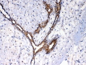 IHC testing of FFPE human breast cancer tissue with NSF antibody at 1ug/ml. Required HIER: steam section in pH6 citrate buffer for 20 min and allow to cool prior to testing.