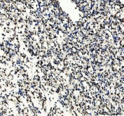 IHC staining of FFPE human melanoma tissue with SOX10 antibody. HIER: boil tissue sections in pH8 EDTA for 20 min and allow to cool before testing.
