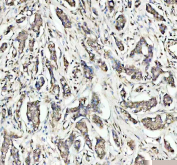 IHC staining of FFPE human breast cancer tissue with OGG1 antibody. HIER: boil tissue sections in pH8 EDTA for 20 min and allow to cool before testing.