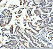 IHC staining of FFPE human lung cancer tissue with OGG1 antibody. HIER: boil tissue sections in pH8 EDTA for 20 min and allow to cool before testing.