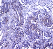 IHC testing of FFPE human rectal cancer tissue with CD41 antibody at 1ug/ml. Required HIER: steam section in pH6 citrate buffer for 20 min and allow to cool prior to testing.