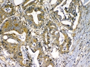 IHC testing of FFPE human rectal cancer tissue with CFD antibody at 1ug/ml. Required HIER: steam section in pH6 citrate buffer for 20 min and allow to cool prior to testing.