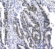 IHC testing of FFPE human rectal cancer tissue with CBX3 antibody at 1ug/ml. Required HIER: steam section in pH6 citrate buffer for 20 min and allow to cool prior to testing.